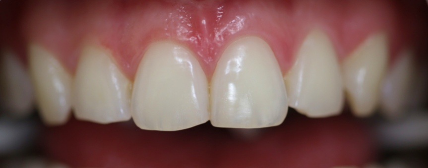 отбеливание зубов фото до и после 1