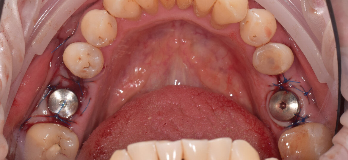 дентальные импланты на жевательных зубах фото