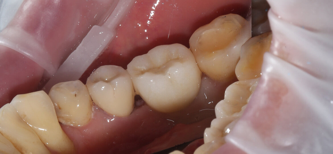 импланты нижних зубов фото