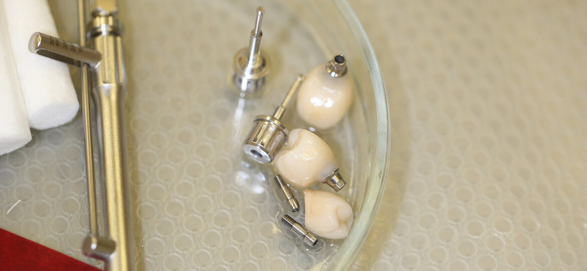 как выглядит зубной имплант фото