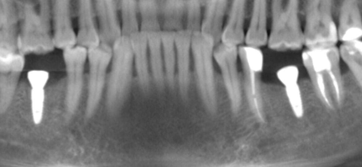 снимок зубных имплантов фото